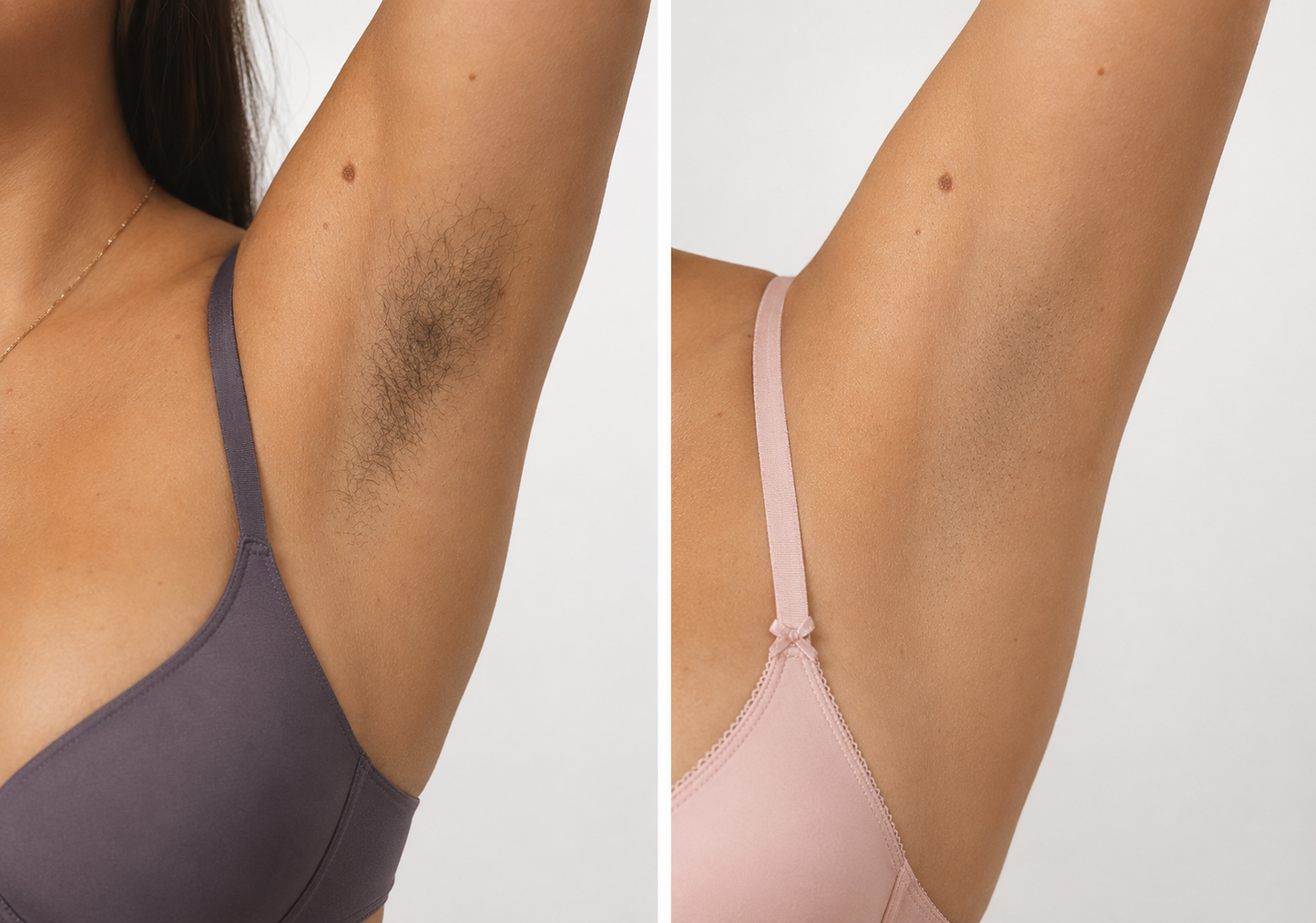 Depiladora Laser IPL Semi-permanente
